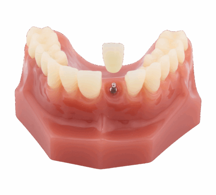 Implantes Dentales en Scranton, PA | Programe una Consulta GRATIS