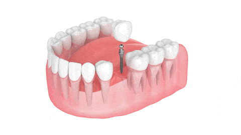 Corona Dental Implantosoportada en Scranton, PA | Reserve una consulta gratuita