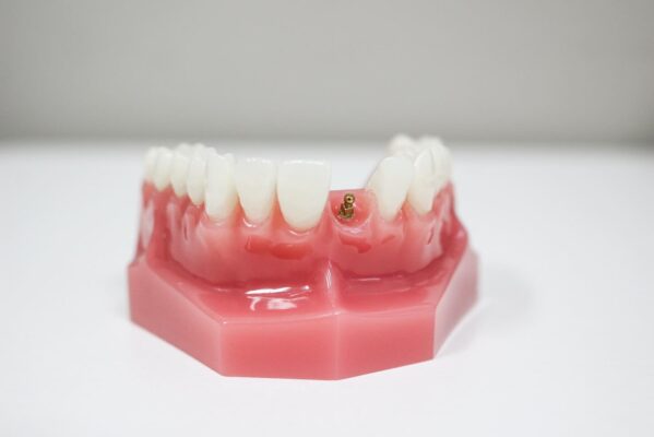 Implantes Dentales el Mismo Día en Scranton, PA | Consultas Gratuitas