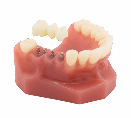 Dental Bridge in Scranton, PA | Book a FREE Consultation Today