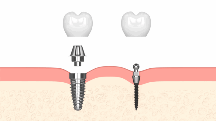 Mini Dental Implants in Scranton, PA | Book a Free Consultation