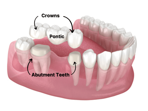 Traditional Dental Bridge in Scranton, PA | Book a Free Consultation