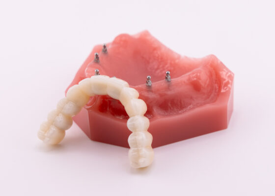 Full Arch Dental Implants in Scranton, PA | Free Consultations