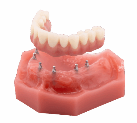 Implant Dentures in Scranton, PA | Schedule a FREE Consultation