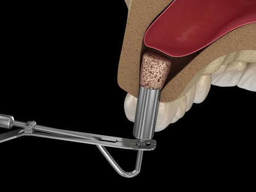 Sinus Lift in Scranton, PA | Schedule a FREE Consultation