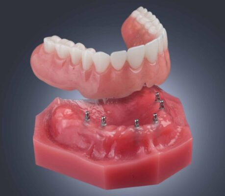 Denture Stabilization in Scranton, PA | Free Consultations Available