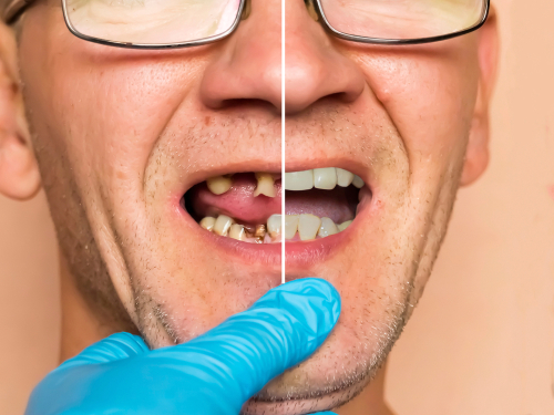 Full-Mouth Restoration in Scranton, PA | Free Implant Consultations
