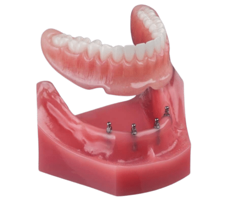 Floating Dentures in Scranton, PA | Free Consults [Video Explainer]