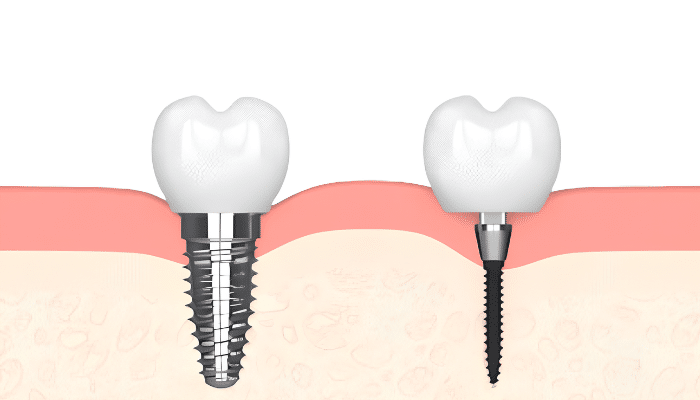 Best Implant Options in 2026 in Scranton, PA [Video Breakdown]