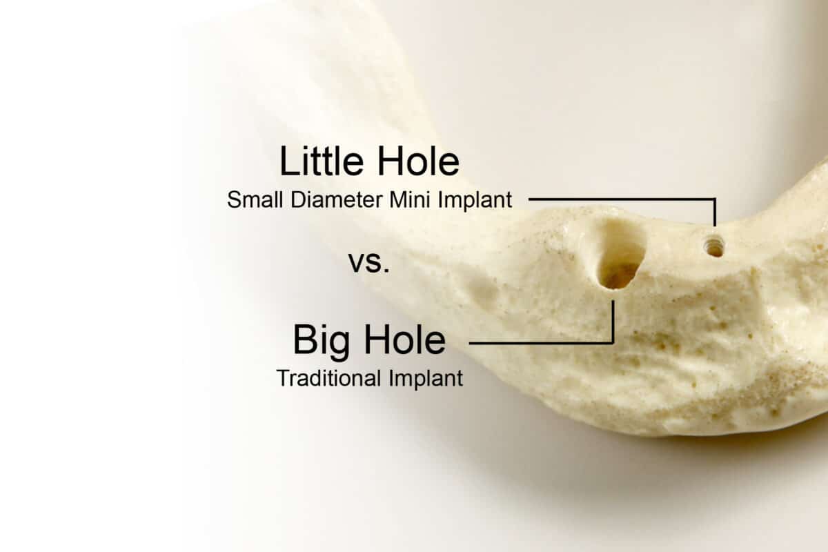 Bone Grafting in Scranton, PA | Free Implant Consults [Video Q&A]