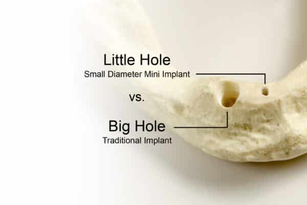 Bone Grafting in Scranton, PA | Free Implant Consults [Video Q&A]