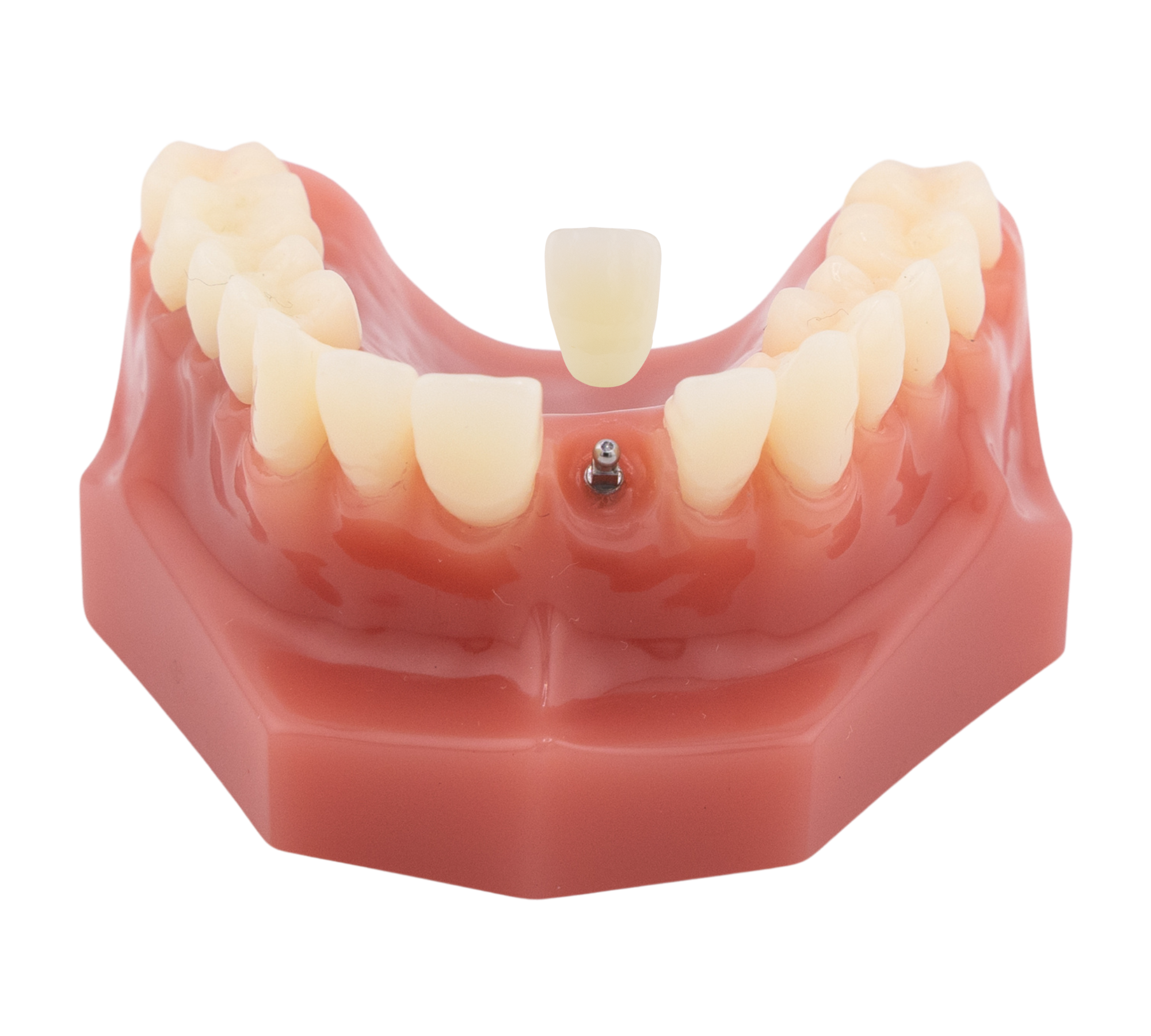 Dental Extraction in Scranton, PA | Free Consults [Video Explainer]