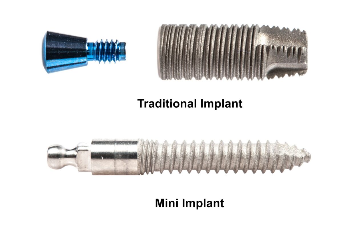 Types of Dental Implants in Scranton, PA [Video Inside]