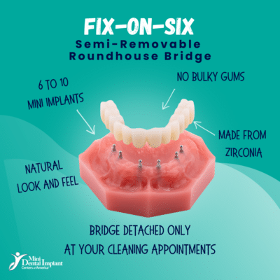 Fix-on-Six in Scranton, PA | Free Mini Implant Consult [Video Q&A]