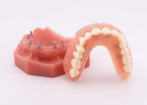 Snap-In Dentures in Scranton, PA | Free Consultations [Video Q&A]