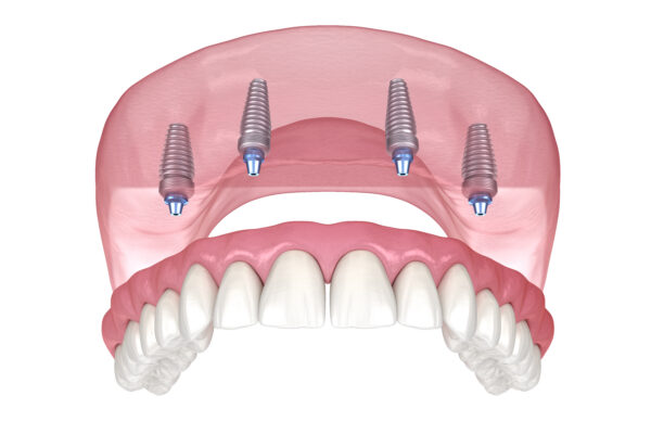 All-on-4 in Scranton, PA | Free Dental Implant Consult [Video Q&A]