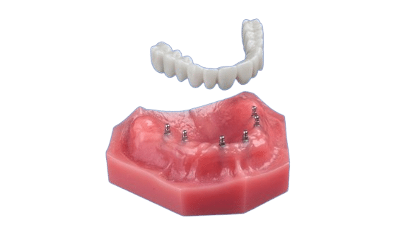 Fix-on-Six in Scranton, PA | Free Mini Implant Consult [Video Q&A]